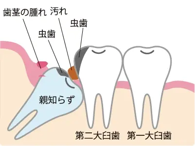 親知らずが引き起こすトラブル