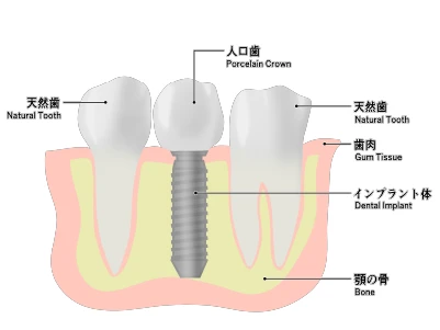 インプラント治療