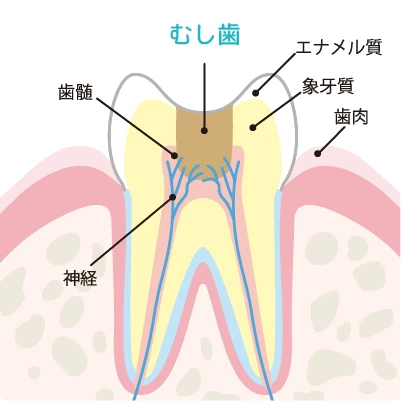 むし歯