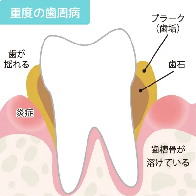 歯周病