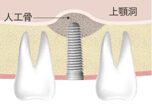 ソケットリフト