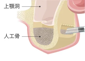 サイナスリフト